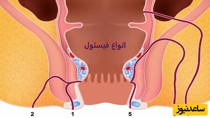 انواع فیستول مقعدی