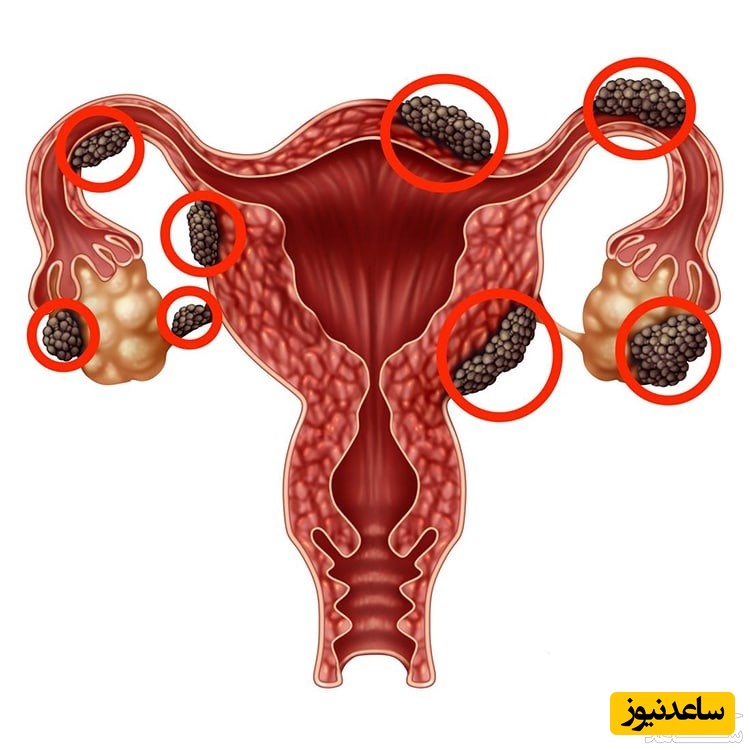 با انواع چسبندگی‌ رحم در زنان بیشتر آشنا شوید