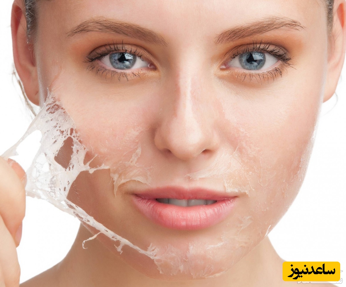 همه چیز درباره لایه برداری پوست با آنزیم تراپی و مزایای آن