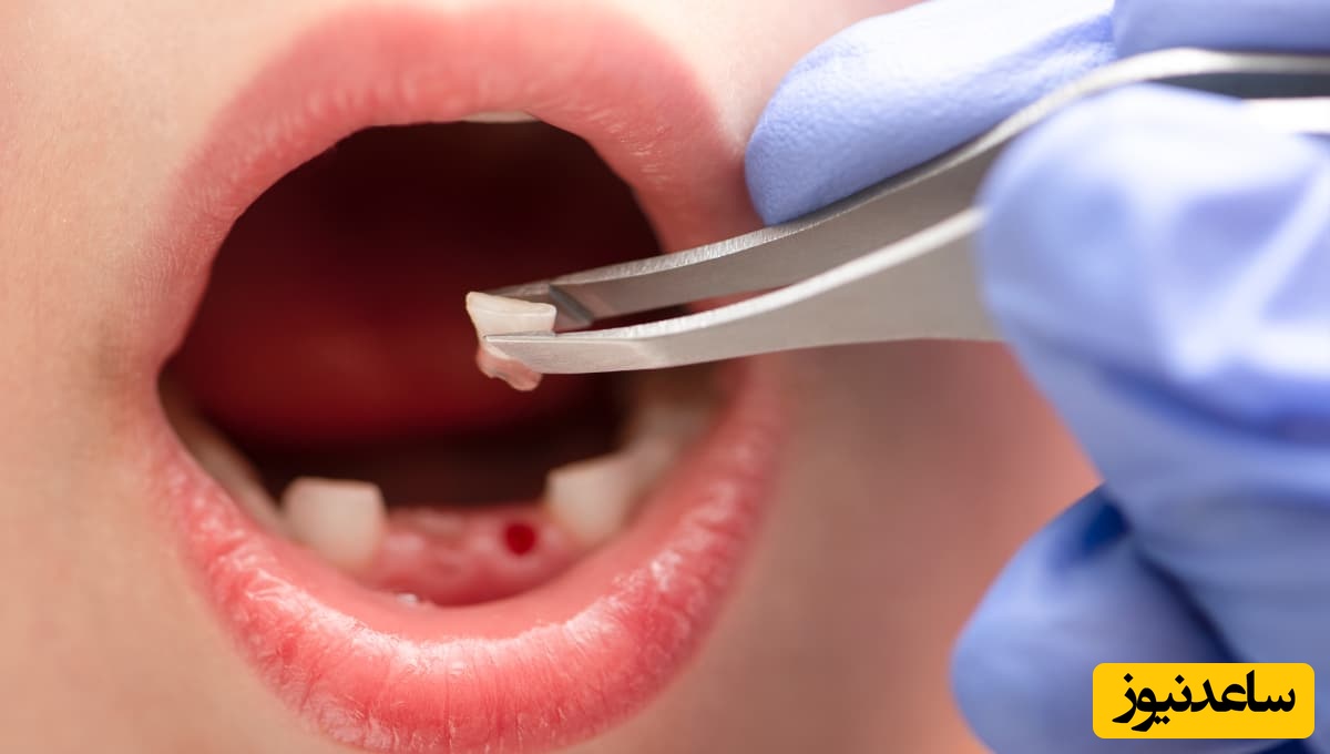 مرگ بر اثر جراحی دندان عقل!