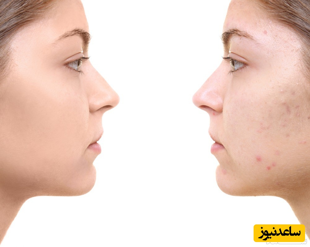 همه چیز درباره پانچ پوست راهکاری بی نظیر برای رفع جای جوش عمیق