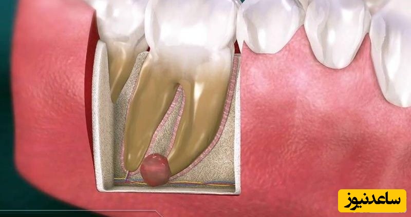 آیا کیست دندان خطرناک است؟