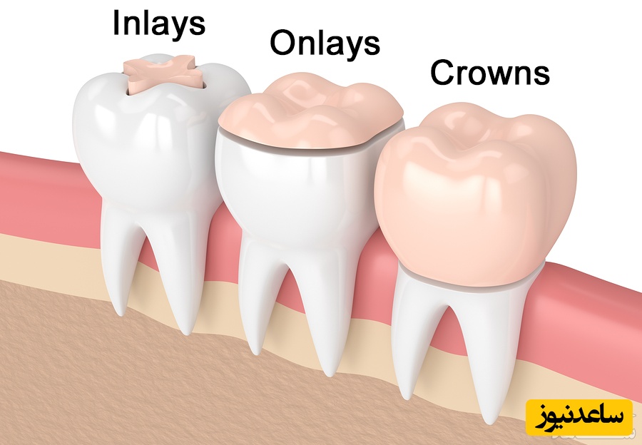 ترمیم دندان به روش اینلی و آنلی