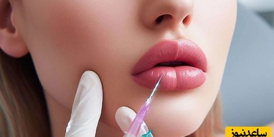 دنیای سلامت؛ مراقبت های ضروری بعد از تزریق ژل لب