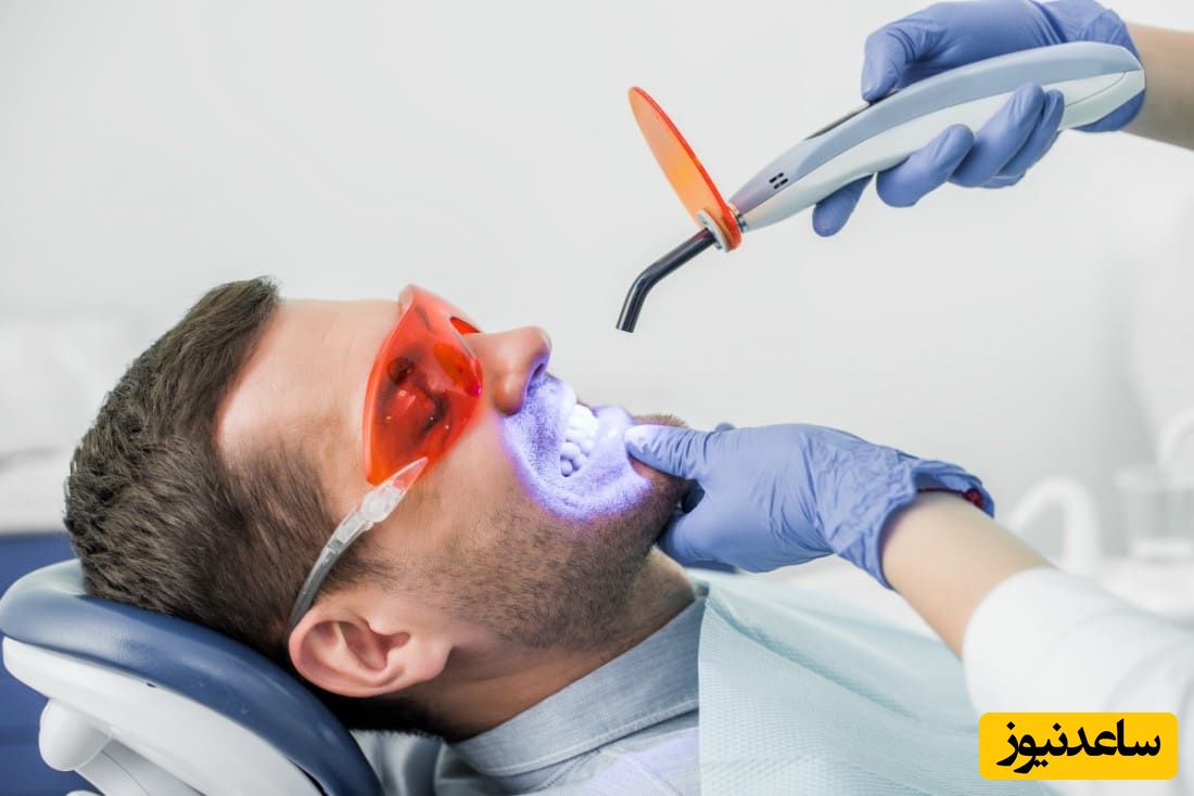 بلیچینگ با لیزر چیست؟