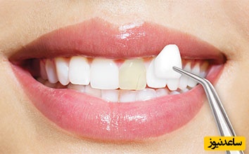 از عوارض لمینت دندان و معایب آن آگاهی دارید؟