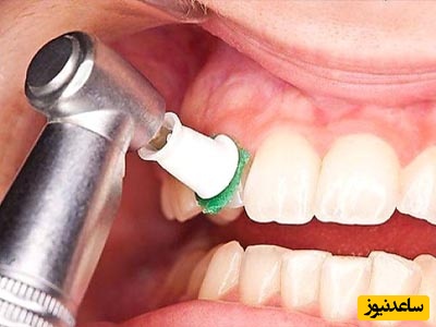 جرم‌گیری مینای دندان را از بین می‌برد؟