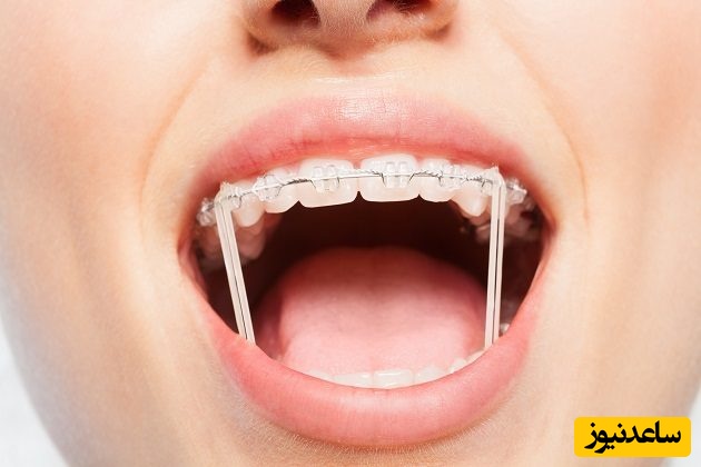 بهداشت دهان و دندان در دوران ارتودنسی بارداری چگونه است؟