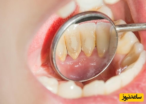 راه‌های سنتی برای از بین بردن پلاک دندان