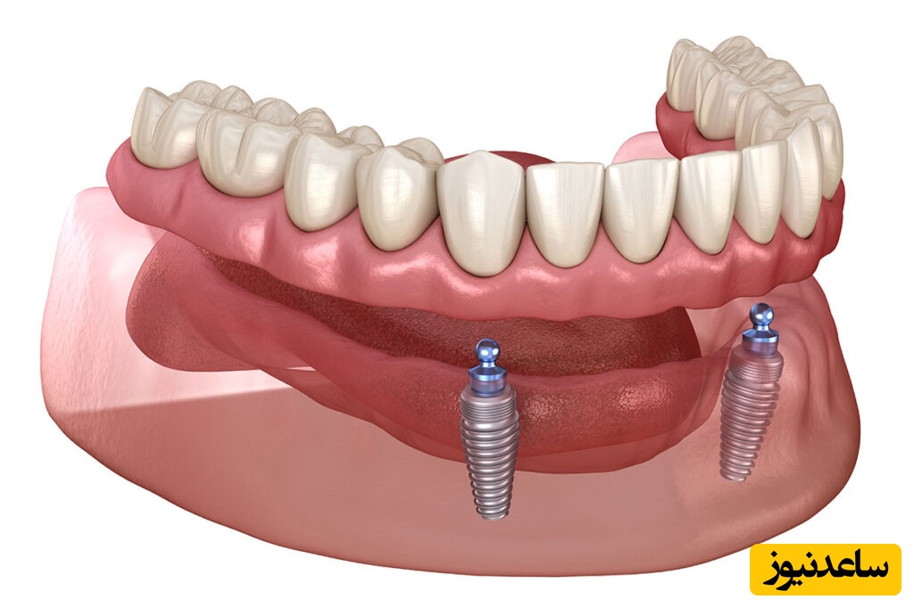 چرا اوردنچر بر پایه ایمپلنت توصیه می شود؟
