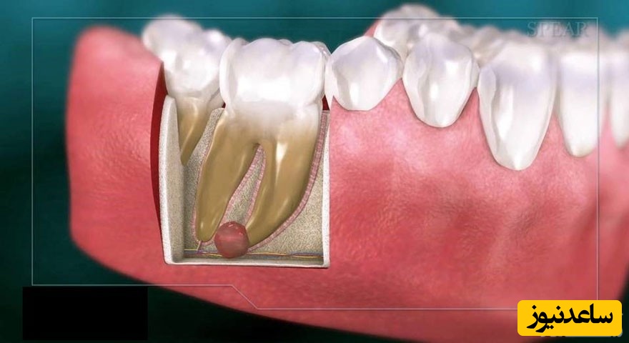 درمان کیست دندان چگونه است؟