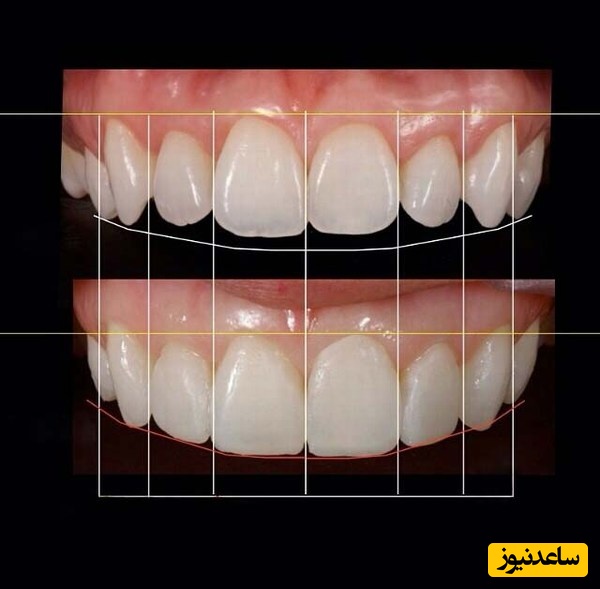 روش اصلاح طرح لبخند چه نقشی در زیبایی لبخند دارد؟