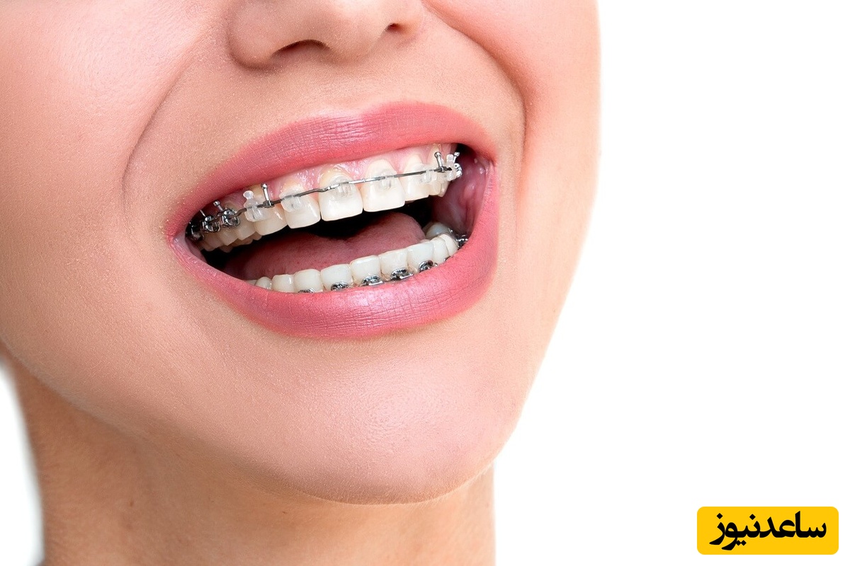 احساس بیمار در زمان قرار گیری کش ارتودنسی چیست؟