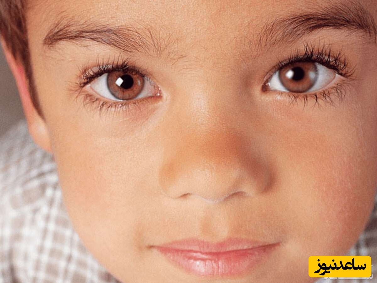 تنبلی چشم در کودکان