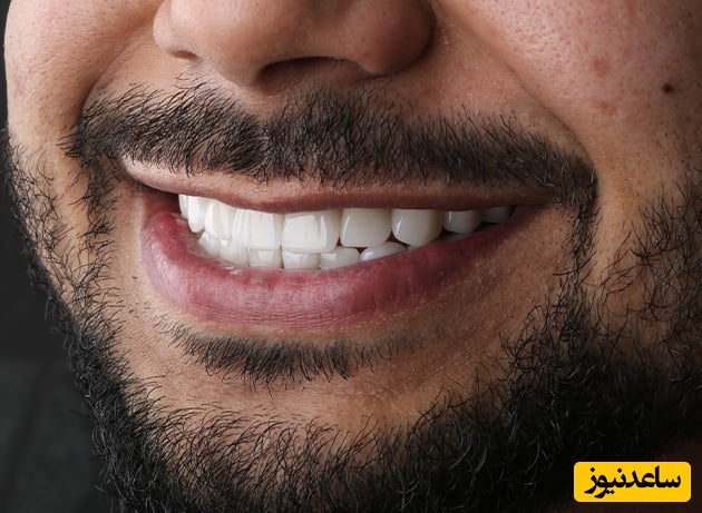 اصلاح طرح لبخند هالیوودی چگونه انجام میشود؟