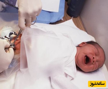 انجام ختنه با حلقه