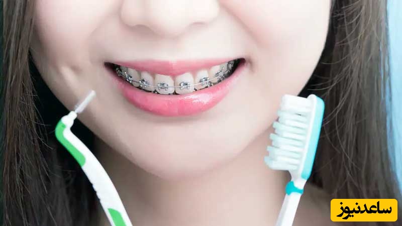 مراحل صحیح مسواک زدن در طی درمان ارتودنسی