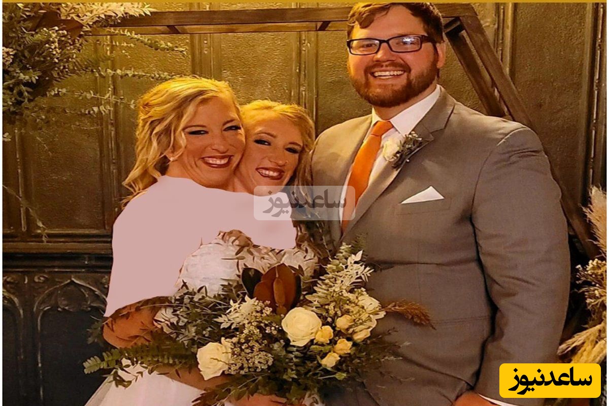 دوقلو‌های به هم چسبیده،