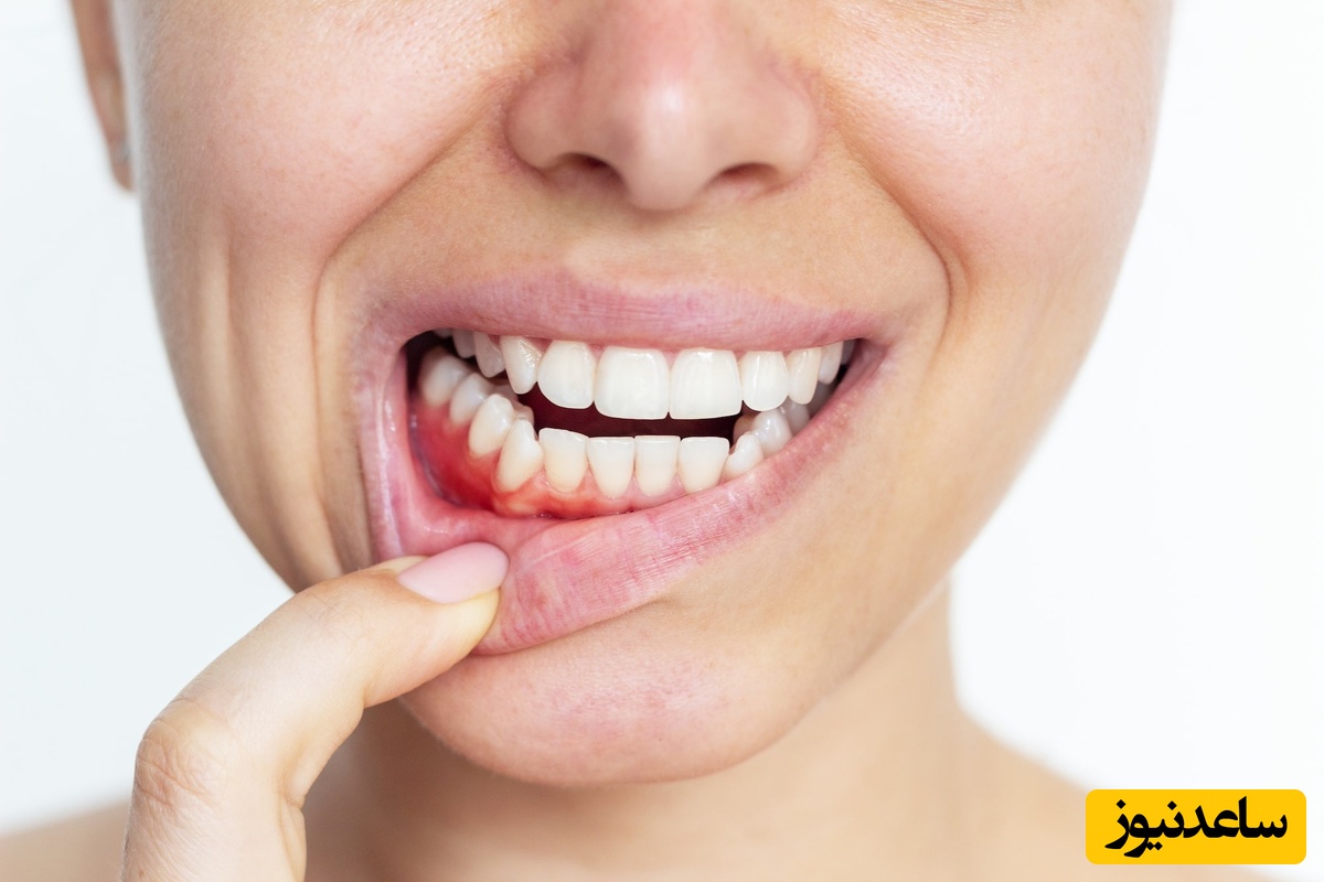 درمان عفونت لثه در کودکان