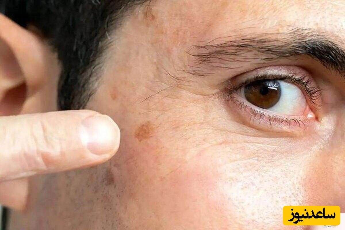 خطر مرگ/ این نشانه‌های پنهان روی پوست را جدی بگیرید