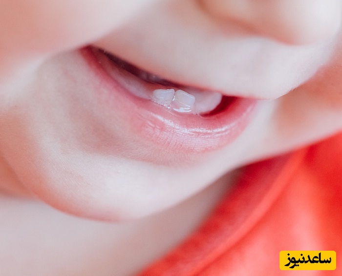 علت کشیدن دندان های کودکان چیست؟