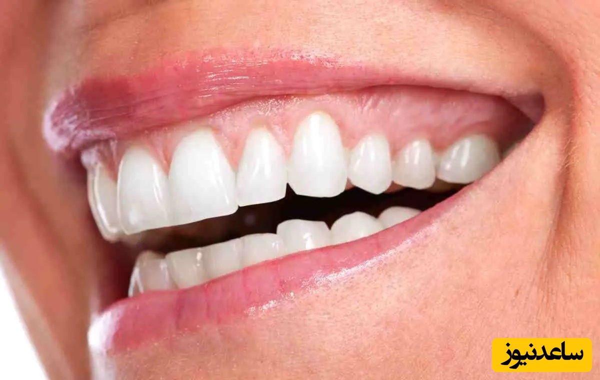 لیفت لثه چگونه انجام می شود؟