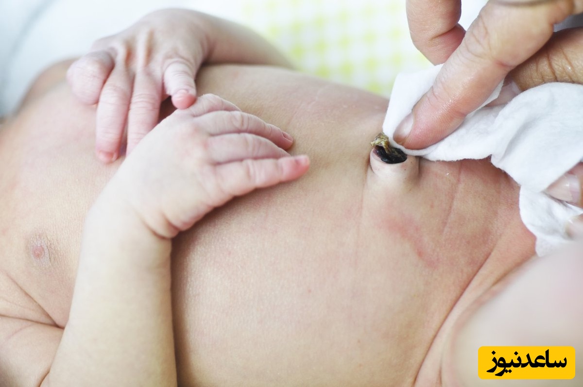 فتق ناف کودک