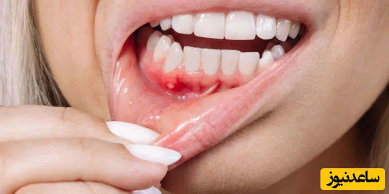 حقایقی در مورد آبسه دندان