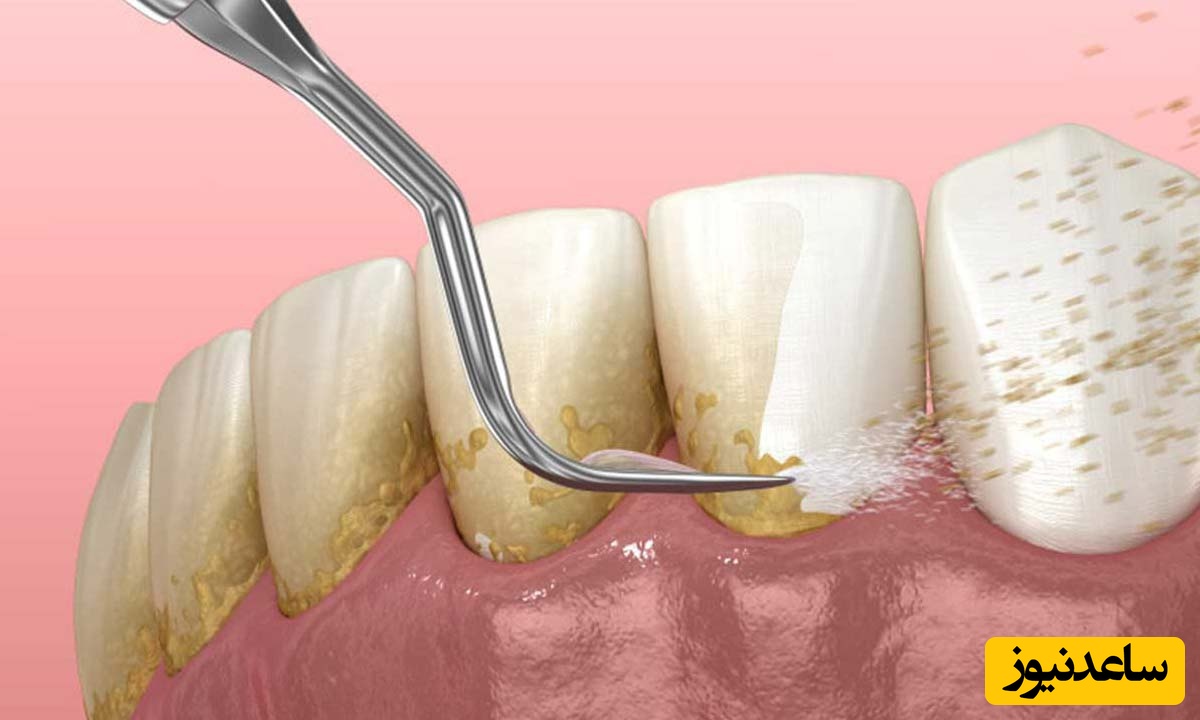 برطرف کردن زردی و لک دندان با چند راه ساده
