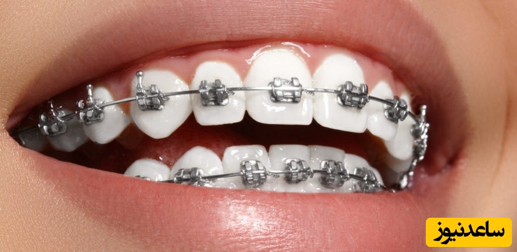 اورتودنسی با براکت های فلزی