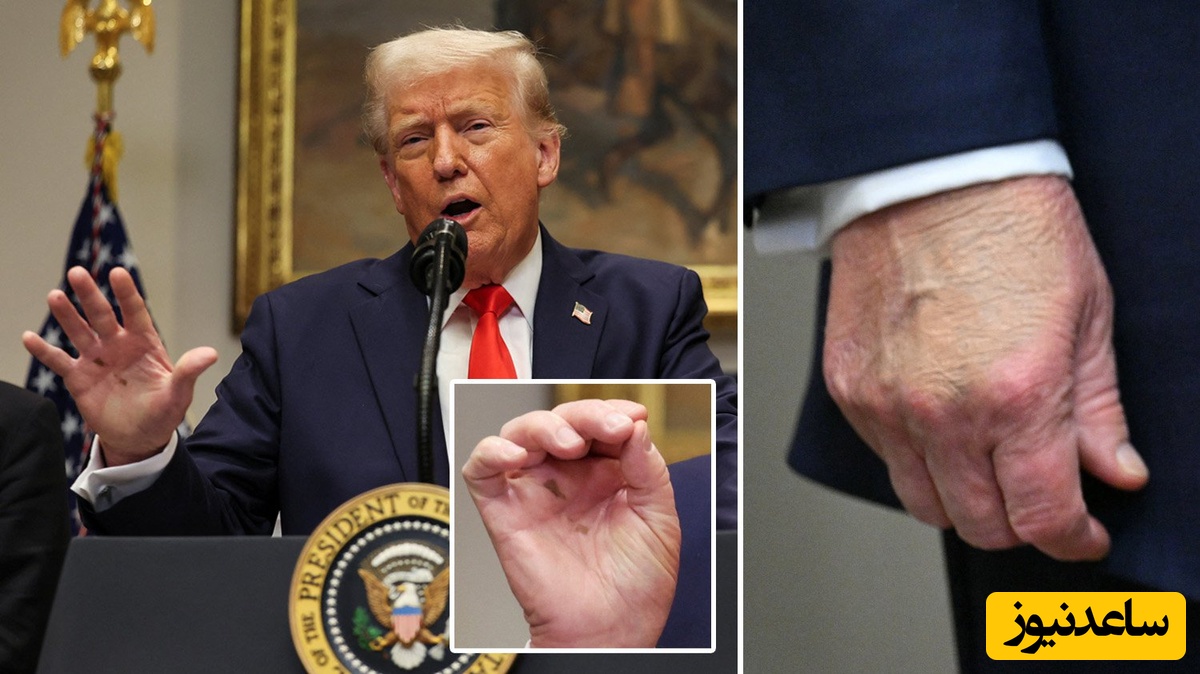 حاشیه‌های تمام نشدنی ترامپ 79 ساله از آمریکا؛ استفاده ناشیانه از کرم‌پودر ملانیا برای مشخص نشدن کبودی روی دستش!+عکس