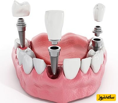 معروف ترین برند های ایمپلنت دندان در جهان چیست؟
