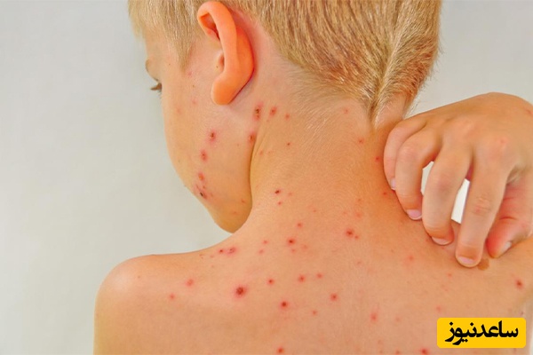 درمان خانگی آبله مرغان
