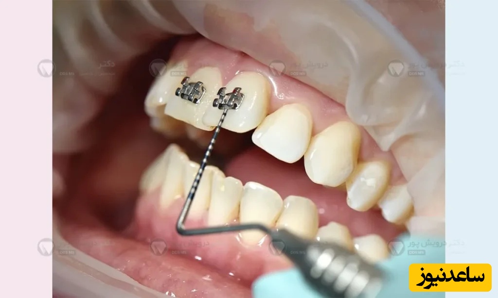 برای جلوگیری از عفونت حین ارتودنسی چه کار هایی باید انجام داد؟