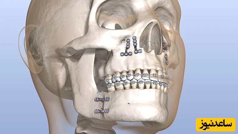 چه کسانی به جراحی اصلاح فک نیاز دارند؟