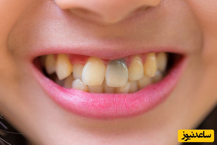 درمان تغییر رنگ دندان‌ها در کودکان