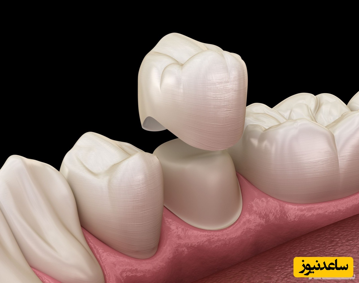 کاربردهای روکش دندان در دندانپزشکی چیست؟