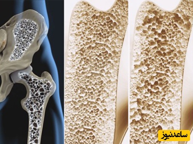ارتباط مستقیم بین کمبود ویتامین با پوکی استخوان