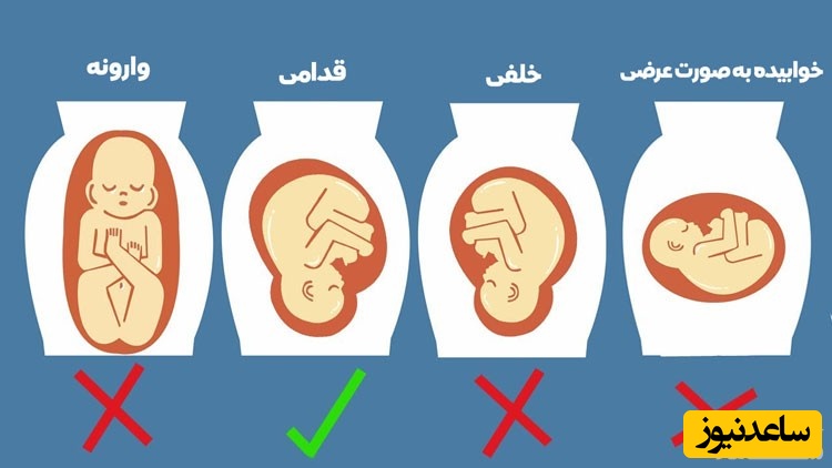 وضعیت قرارگیری جنین در رحم