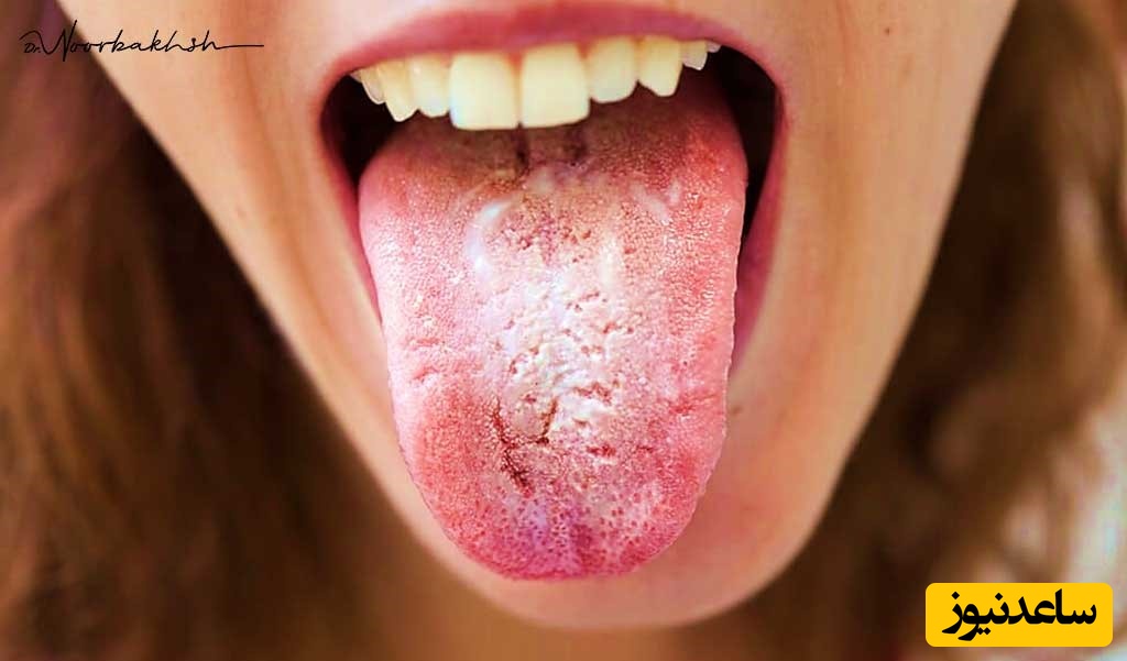 لکه های سفید روی لوزه ها چیست؟