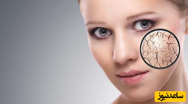 پوست دهیدراته چیست؟