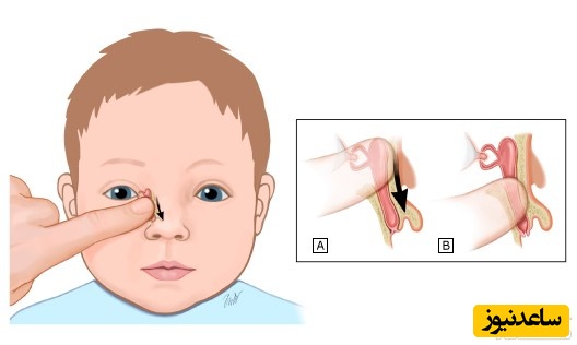 نحوه ماساژ چشم برای باز شدن مجرای اشکی در کودکان