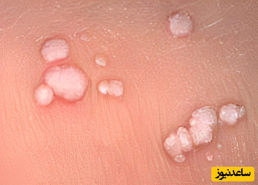 زگیل تناسبی