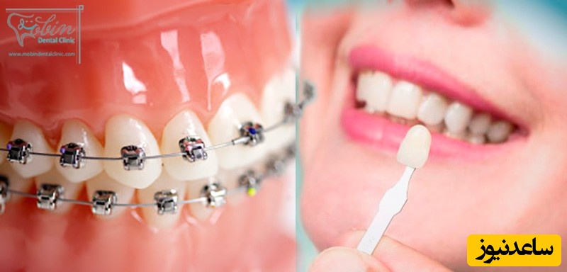 تفاوت لمینیت با ارتودنسی