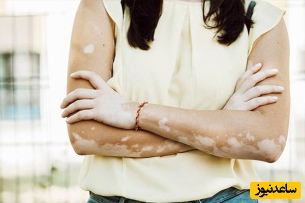 لکه های سفید روی پوست از کمبود چه ویتامینی است؟