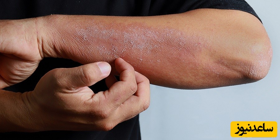 بیماری اگزما یا خارش پوست چه علائمی دارد و راه درمان آن چیست؟
