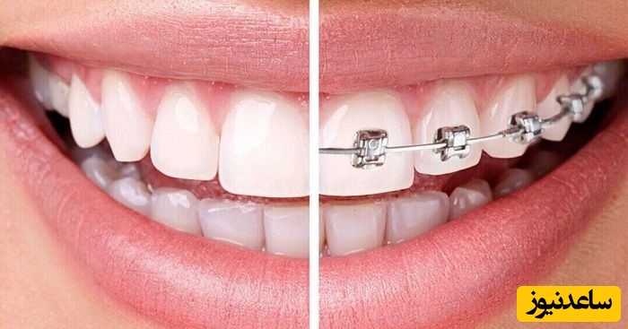 دستگاه های ارتودنسی در طول درمان چگونه عمل میکنند؟