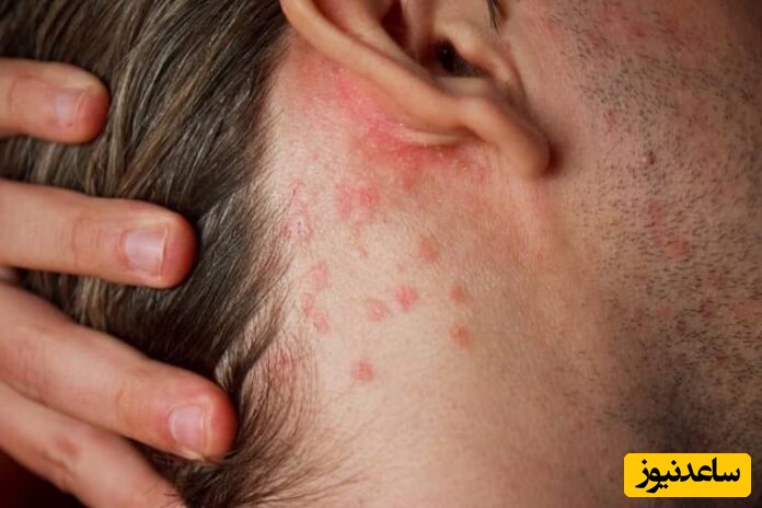 درمان جوش کنار گوش؛ راهکارهای ساده و قطعی برای رهایی از جوش‌های مزاحم