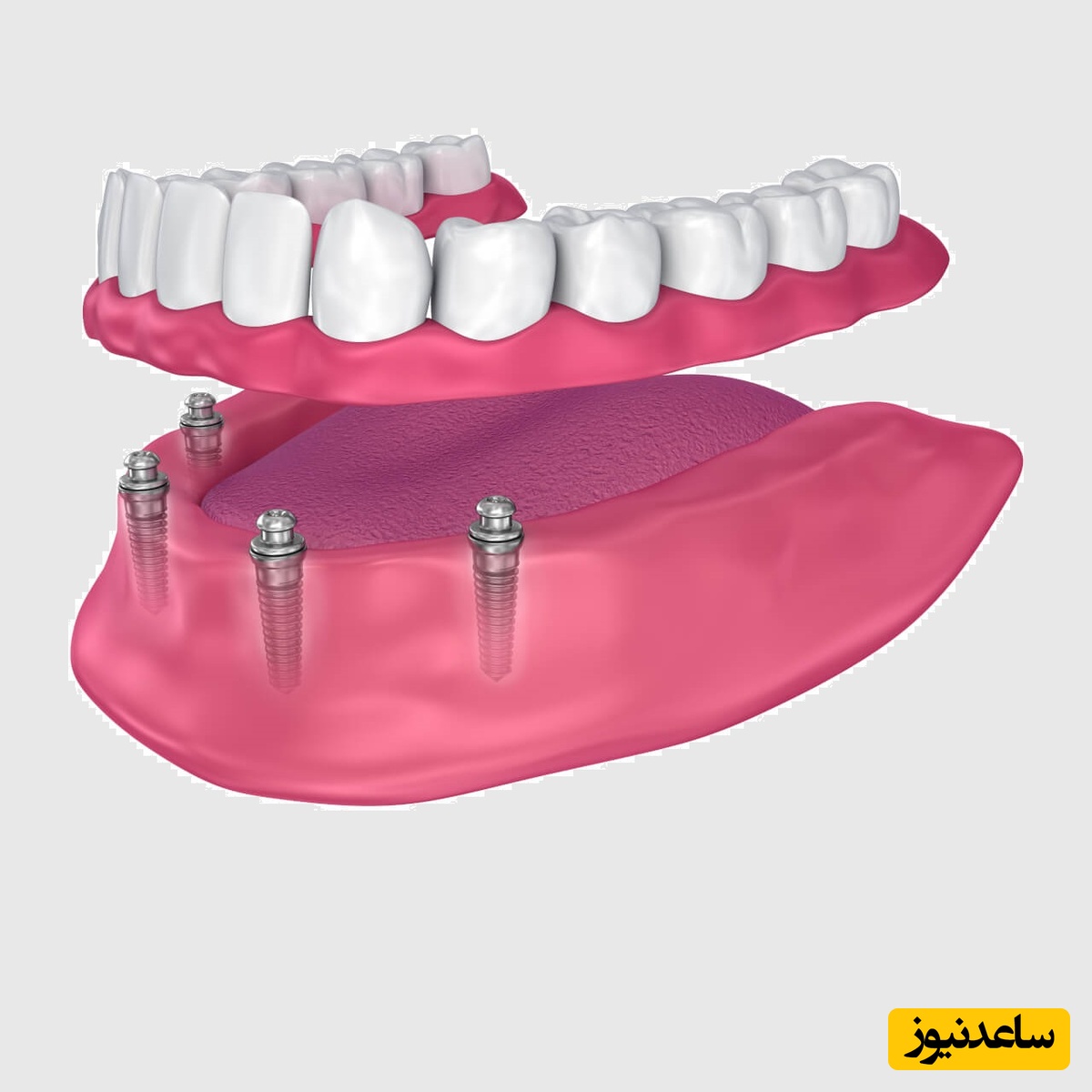 تفاوت اوردنچر با دندان مصنوعی سنتی چیست؟