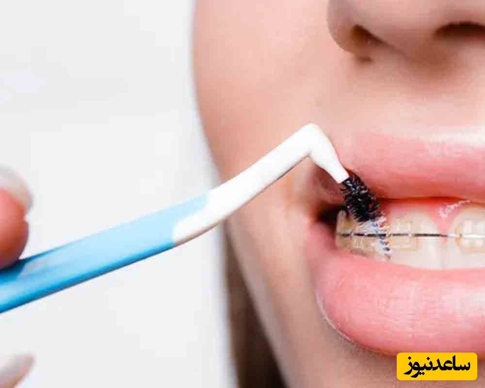 اهمیت انتخاب بهترین خمیردندان و دهانشویه در زمان ارتودنسی